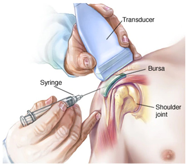 Bursa Surgery in Pune